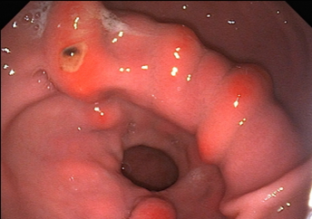 Squamous ulceration
